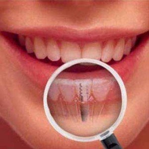 dental-implants