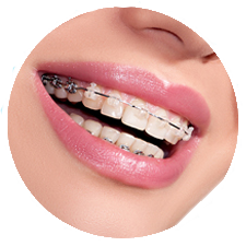 I want to get my teeth straightened and want to know the cost of dental  braces in Jaipur. - Face Kraft Clinic