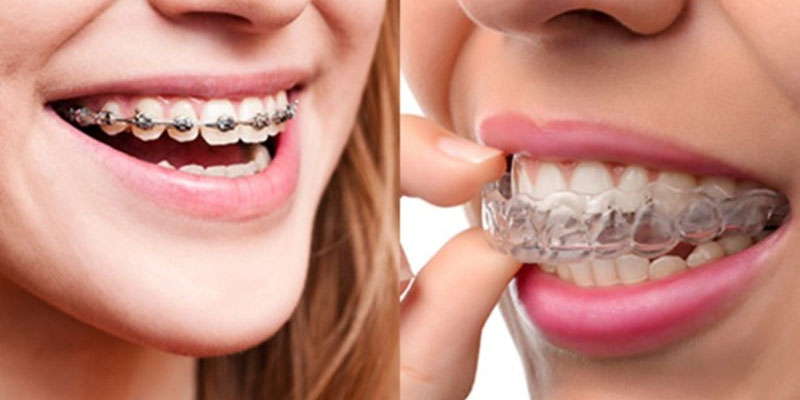 What is the cost of dental braces?