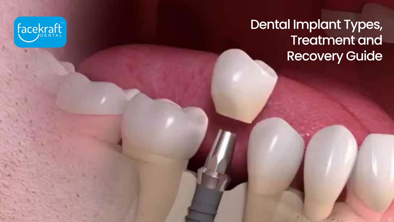 Dental Implant Types, Treatment and Recovery Guide
