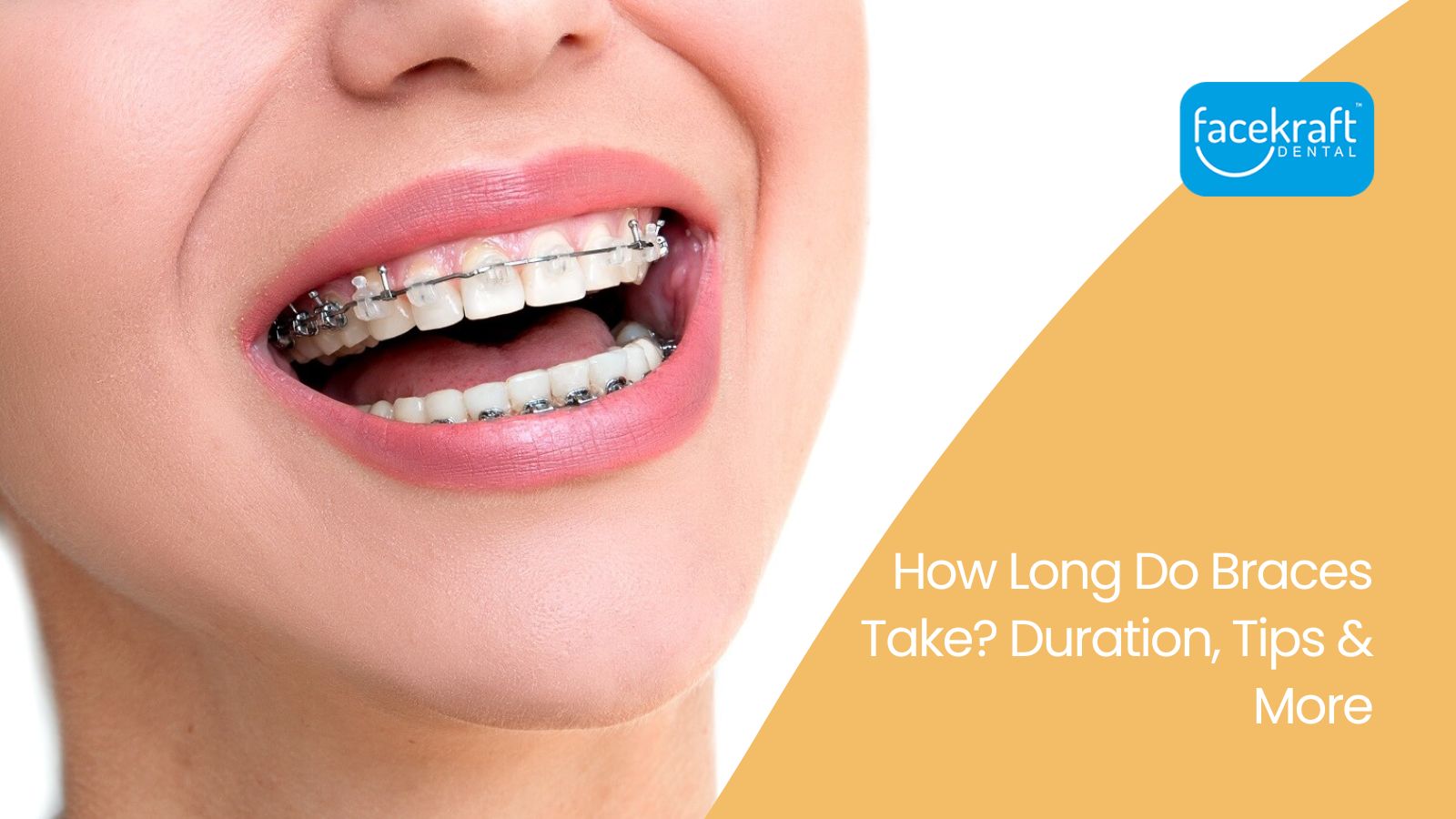How Long Do Braces Take? Duration, Tips & More