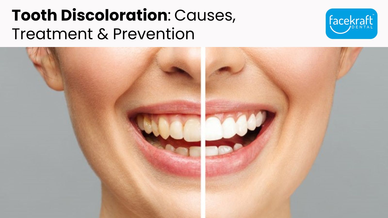 Tooth Discoloration: Causes, Treatment & Prevention