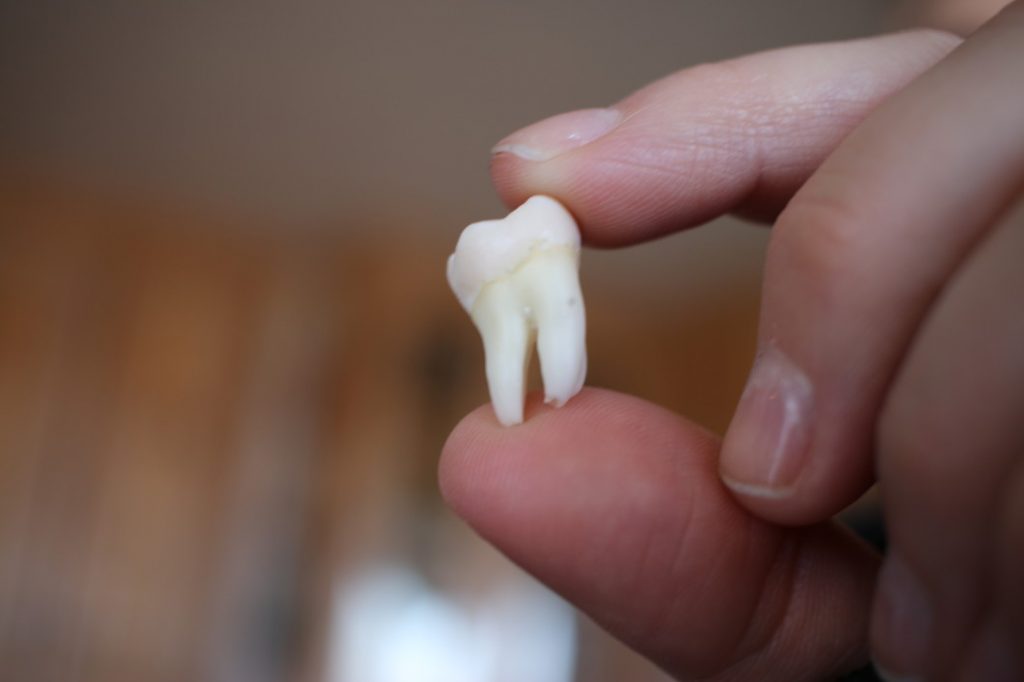 What to do after wisdom tooth removal procedure?