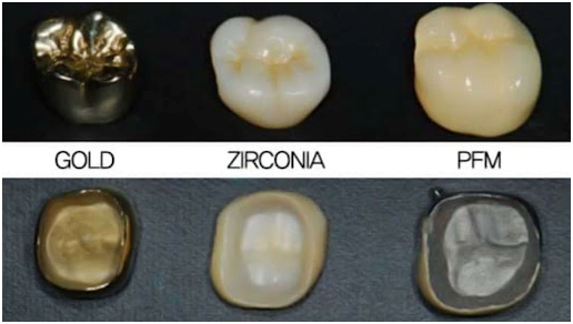Zirconia crowns – Advantages, Disadvantages and Cost