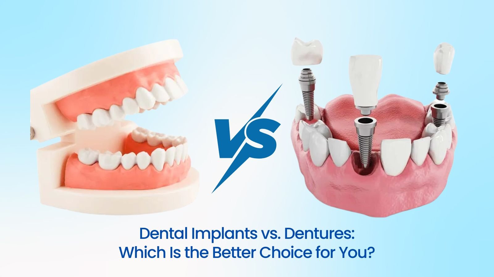 Dental Implants vs. Dentures: Which Is the Better Choice for You?