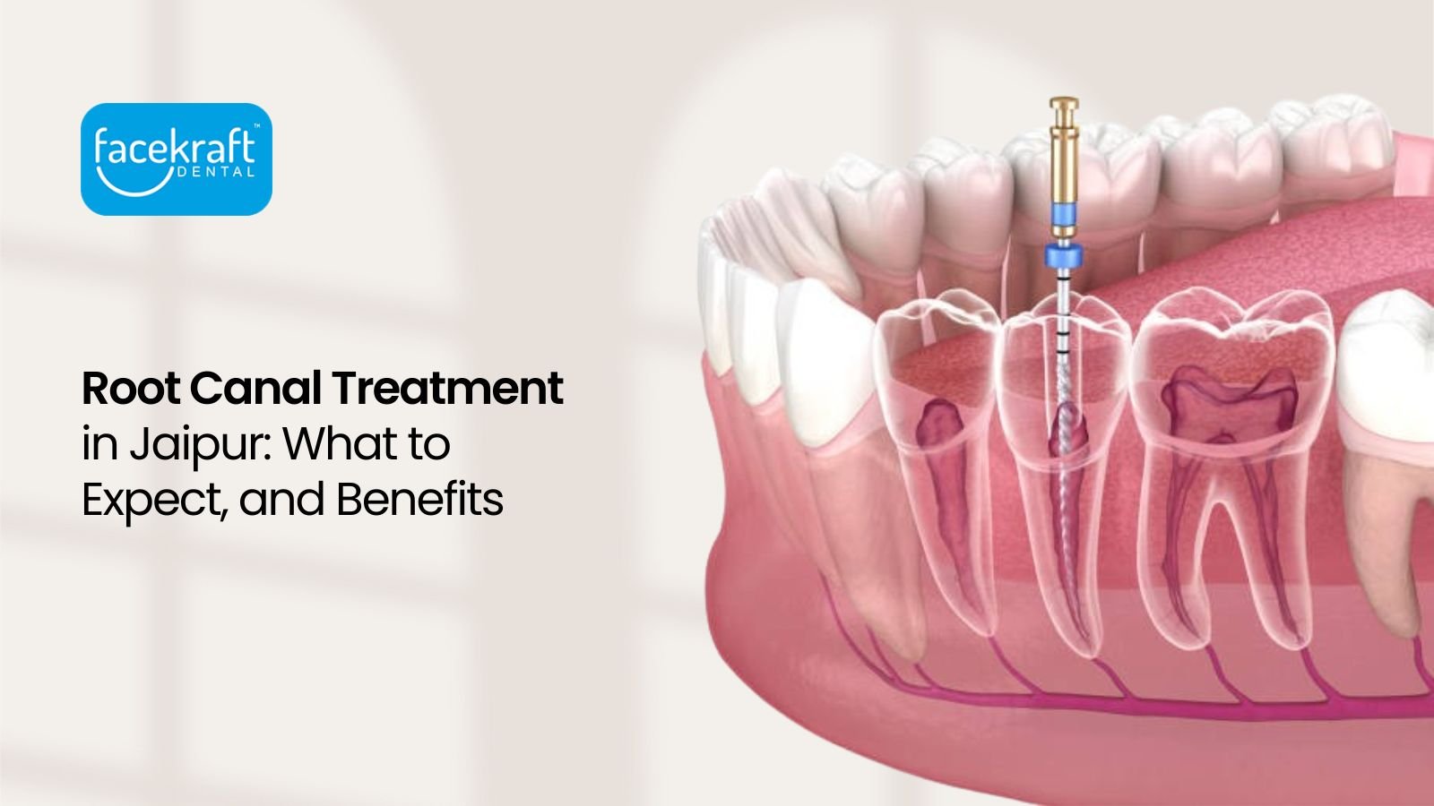 Root Canal Treatment in Jaipur: What to Expect, and Benefits